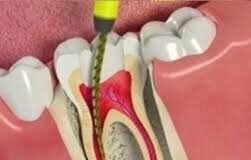 Find Best Dentist in Noida For Root Canal Treatment RCT in Noida