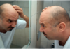 8 Benefits of Scalp Micropigmentation Micropigmentation