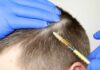 Bad Line Up- How to fix a push-back hairline? Bad Line Up